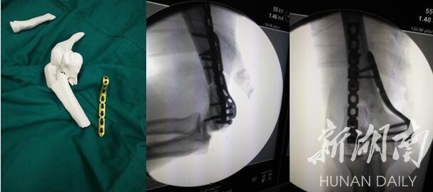 郴州市醫(yī)院借助3D打印完成骨科手術
