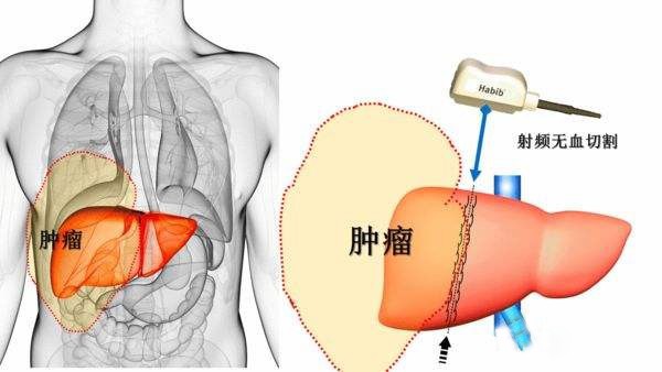 放射性粒子治療腫瘤，3D打印技術可望減少“多余”劑量