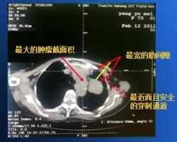 3D打印“引路”放射性粒子精準(zhǔn)殺傷腫瘤